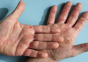 Confirmada a primeira morte por varíola dos macacos no Brasil. Doença está avançando para outras populações, diz infectologista